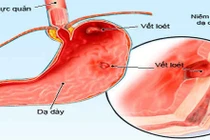 Trị tận gốc bệnh dạ dày, cần tuân thủ nguyên tắc gì?