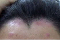 Vảy nến: Lành tính nhưng khó chữa