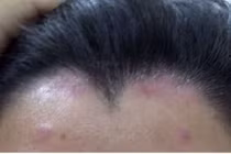 Vảy nến: Lành tính nhưng khó chữa