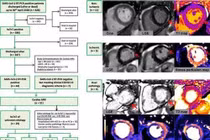 Cẩn thận với tổn thương tim phổi của hội chứng hậu Covid-19
