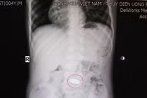 Ngậm đồng xu chui xuống dạ dày