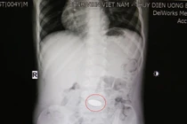 Ngậm đồng xu chui xuống dạ dày