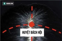 Day huyệt bách hội chữa huyết áp thấp, rối loạn tiền đình