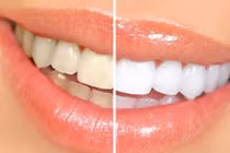 Top những loại thực phẩm giúp răng trắng sáng bất ngờ