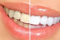 5 sai lầm khi vệ sinh răng miệng 