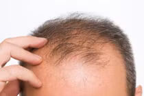 Chữa hói đầu bằng… nốt ruồi 