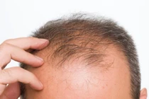 Chữa hói đầu bằng… nốt ruồi 