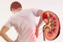 Sau tán sỏi thận ăn gì để nhanh hồi phục sức khoẻ?