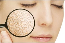 3 cách khắc phục da khô hiệu quả tại nhà 