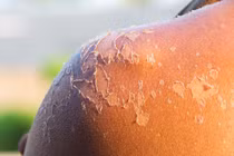 Cách xử lý khi da bị cháy nắng