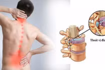 Người bị thoát vị đĩa đệm có nên tập thể thao?