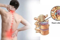 Người bị thoát vị đĩa đệm có nên tập thể thao?
