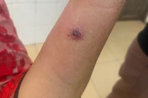 Điện Biên ghi nhận trường hợp trẻ nhỏ mắc bệnh than: Vì sao hiếm gặp?