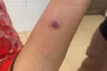 Điện Biên ghi nhận trường hợp trẻ nhỏ mắc bệnh than: Vì sao hiếm gặp?