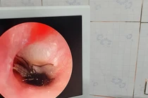 Bé trai 2 tuổi ở Hà Tĩnh bị gián chui vào tai