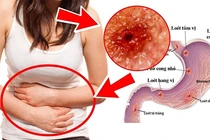 6 loại thực phẩm giúp cải thiện viêm loét dạ dày