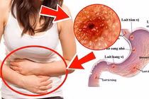6 loại thực phẩm giúp cải thiện viêm loét dạ dày