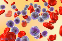 Ung thư máu có những triệu chứng gì?