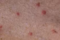 Hơn 140 người cùng một thôn ở Quảng Ngãi mắc bệnh ghẻ