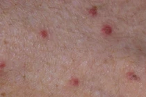 Hơn 140 người cùng một thôn ở Quảng Ngãi mắc bệnh ghẻ