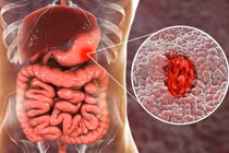 5 thực phẩm cực tốt cho bệnh nhân chảy máu dạ dày