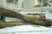 Dấu hiệu người nhiễm vi khuẩn liên cầu lợn