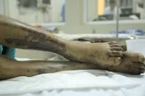 Dấu hiệu người nhiễm vi khuẩn liên cầu lợn