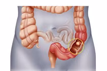 Người ung thư trực tràng nên ăn gì để tốt cho cơ thể?