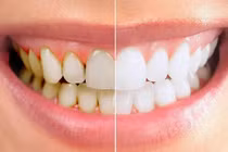 Giải quyết vấn đề răng ố vàng với những mẹo nhỏ