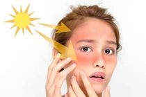 Thực phẩm giúp giảm thiểu tình trạng cháy nắng