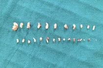 Hơn 28 chiếc răng dị dạng trong khối u của bé trai 9 tuổi