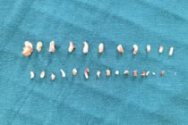 Hơn 28 chiếc răng dị dạng trong khối u của bé trai 9 tuổi