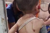 Điều tra vụ bé trai chi chít vết thương trên người nghi bị bạo hành