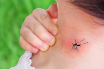 Mẹo xử lý vết ngứa khi bị muỗi đốt