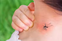 Mẹo xử lý vết ngứa khi bị muỗi đốt