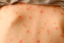 Những biến chứng nguy hiểm của bệnh thủy đậu cần lưu ý ngay 