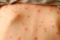 Những biến chứng nguy hiểm của bệnh thủy đậu cần lưu ý ngay 
