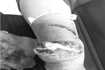 Chân vịt tàu cao tốc chém 3 nhát nát chân người thợ