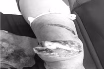 Chân vịt tàu cao tốc chém 3 nhát nát chân người thợ