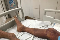 Bác sĩ chỉ rõ đối tượng dễ nhiễm liên cầu khuẩn lợn