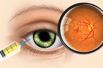 Phương thức điều trị mới cho thoái hóa hoàng điểm do tuổi già