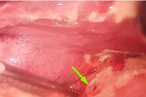 Bác sĩ chỉ rõ lý do trẻ thủng hành tá tràng do áp lực thi cử