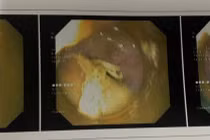 Xương gà 2,5 cm cắm vào thành thực quản tạo ổ áp xe