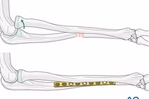 Cẩn thận trẻ liệt thần kinh quay khi ngã chống tay