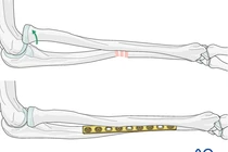 Cẩn thận trẻ liệt thần kinh quay khi ngã chống tay