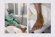 Truyền 10 lọ huyết thanh cứu người bệnh bị rắn lục đuôi đỏ cắn