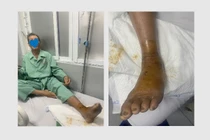 Truyền 10 lọ huyết thanh cứu người bệnh bị rắn lục đuôi đỏ cắn