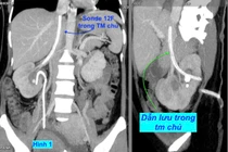 Quá hy hữu: đặt dẫn lưu thận vào tĩnh mạch chủ bụng
