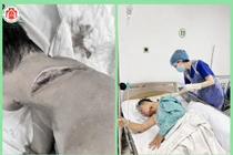 Bệnh nhân bị vi khuẩn ăn thịt người tấn công cổ: Bác sĩ chỉ cách tránh