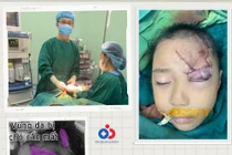 Ngồi chơi trước nhà bé 5 tuổi bị chó cắn rách mặt nặng nề